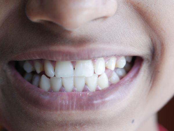 Primer plano de una sonrisa sana, ilustrativo del cuidado dental
